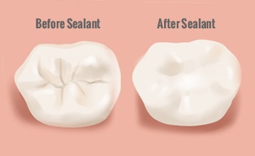 Πριν και μετά το οδοντικό σφράγισμα - Before and after dental sealant