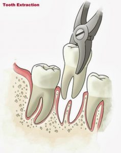 εξαγωγή δοντιού - tooth extraction visualization