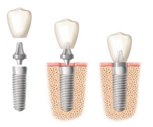 τα μέρη του οδοντικού εμφυτεύματος ,Dental implant parts