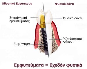 Περιγραφή οδοντικού εμφυτεύματος σε σχέση με το φυσικό δόντι